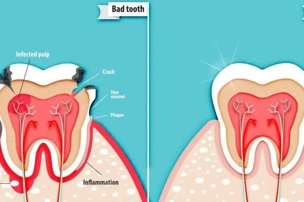 Pulpotomy-Pulpectomy-img (1)