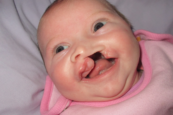 cleft palate